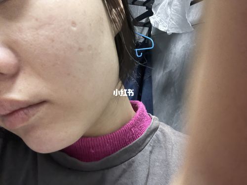 凹陷疤痕_疤痕_变美_点阵激光_点痣_周末_我的变美进化史_美妆_医美