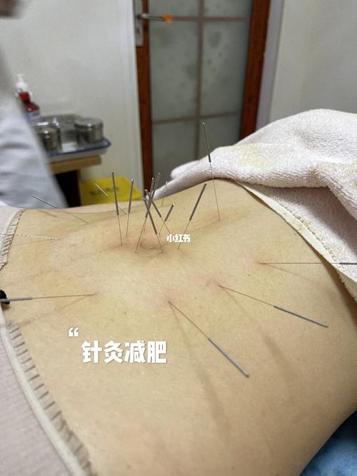 针灸减肥到底会瘦吗?_减肥_针灸_减肥日常_减肥_减肥