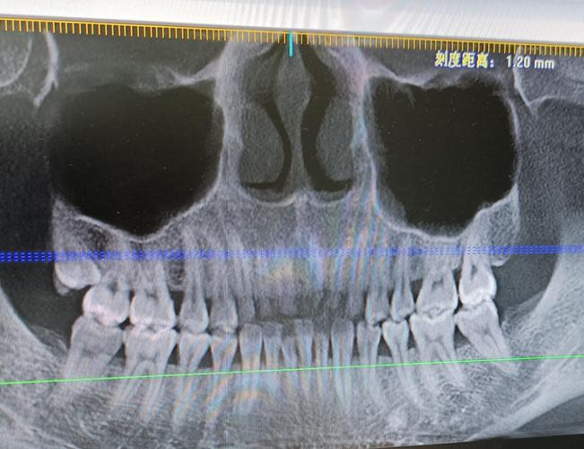 第一次拍牙片,医生说我牙根挺长的,嘿嘿. 牙周不好,哎