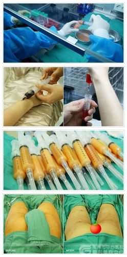 荆州做自体脂肪抽脂隆胸手术多少钱?