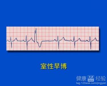 室性早搏可以服用什么药