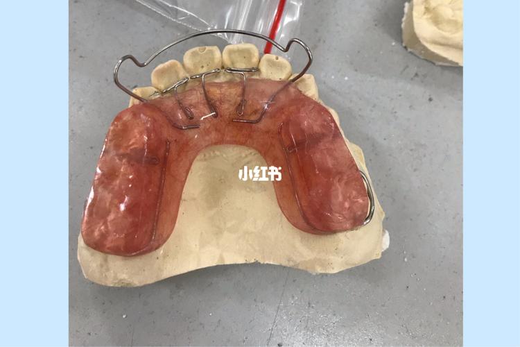 91下颌唇弓 舌侧推簧 后牙颌垫 91_美妆_医美_整容_美妆_医美整形