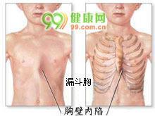 漏斗胸 (胸壁内凹)