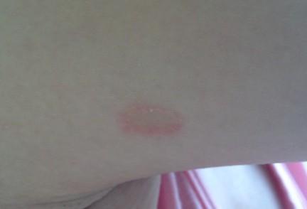 皮肤上起了一圈红圈 中间白的 请问是什么