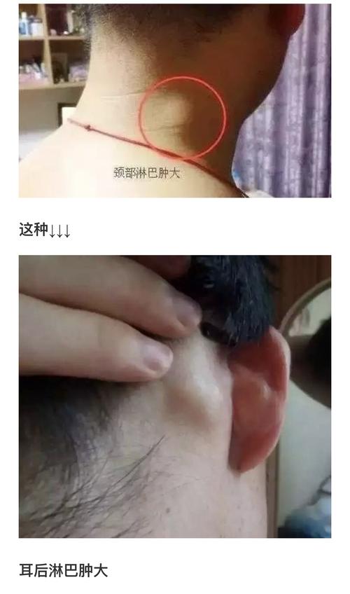 淋巴癌是世界上唯一不能治愈的癌症!不可不通!