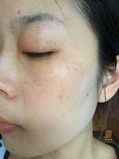 因为脸上的斑 男朋友有点嫌弃 我该怎么办