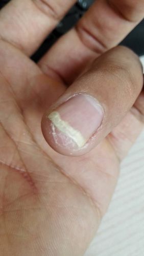 指甲缝里有白色硬物质 用指甲刀刮下来呈粉末状 但过几天又会有 而且