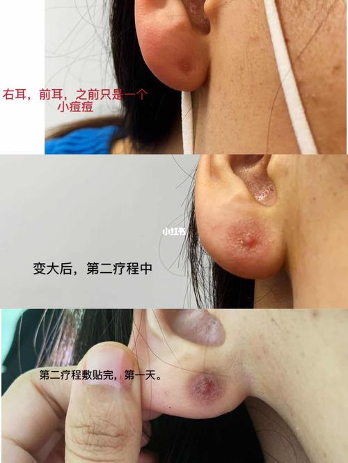 聊聊我的耳洞增生|疤痕疙瘩 -同位素治疗!_疤痕_耳洞