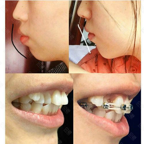 牙齿矫正前后对比