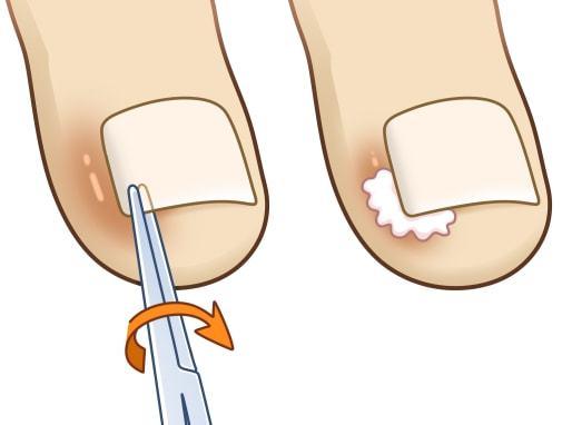 痛得钻心的甲沟炎,竟是这些不良习惯造成的.