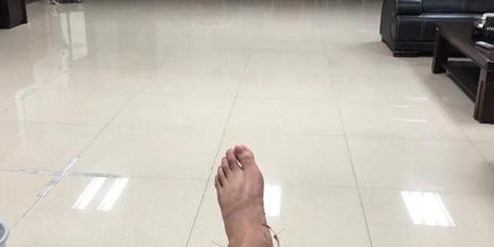 赵睿晒自己脚踝接受针灸治疗的照片