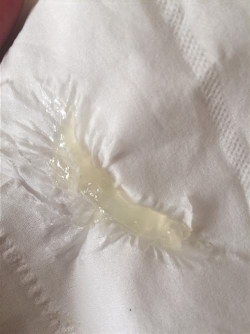 宫颈黏液脓性分泌物