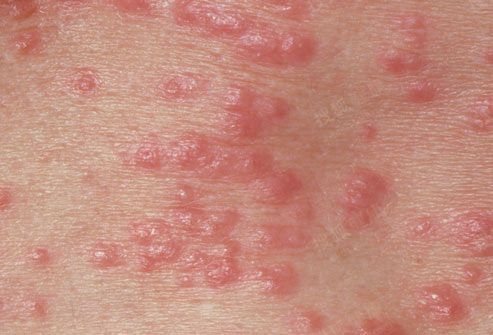 疥疮对成人的危害有哪些?