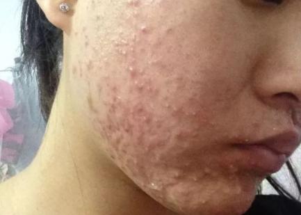 激素脸痒冒白头怎么办 详解封闭性粉刺是激素脸吗