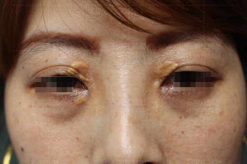 眼皮黄斑瘤怎么治疗?