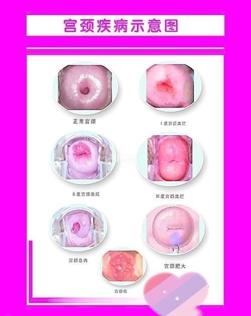 看看你的宫颈是哪种_宫颈糜烂_医疗健康_医疗健康其他