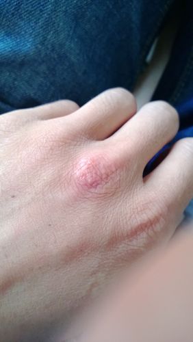 我的手背面中指的位置这是什么皮肤病吗