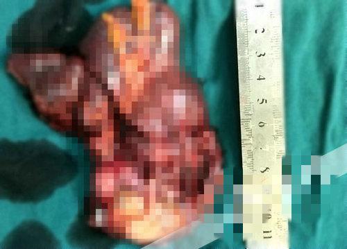 组图:女子怀孕却找不到宝宝 胎儿竟长在脾脏上