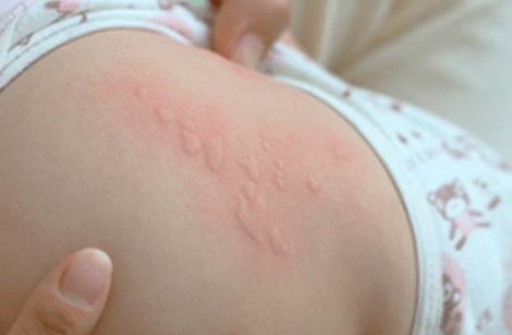 患荨麻疹的宝宝
