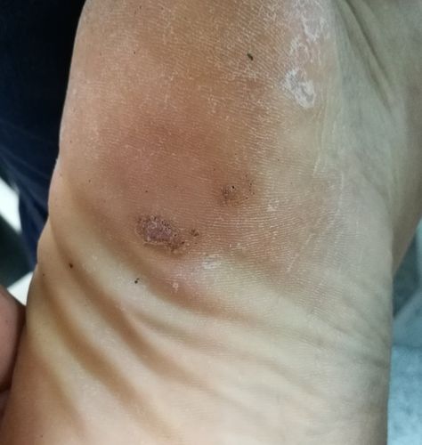 得了病毒疣不要急,看了这篇文章就清楚了