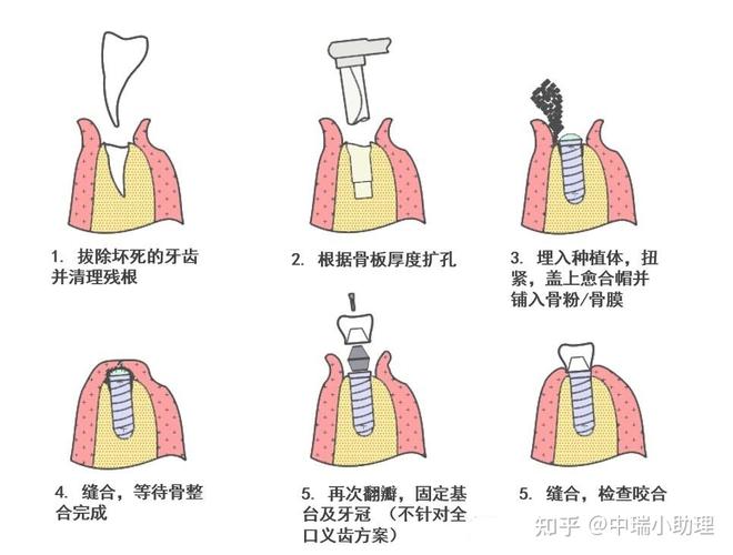 封闭螺丝又称覆盖螺丝,能封闭植入体上方预留连接基台的螺丝孔.