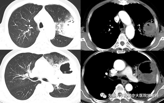 【病例】肺脓肿1例ct影像