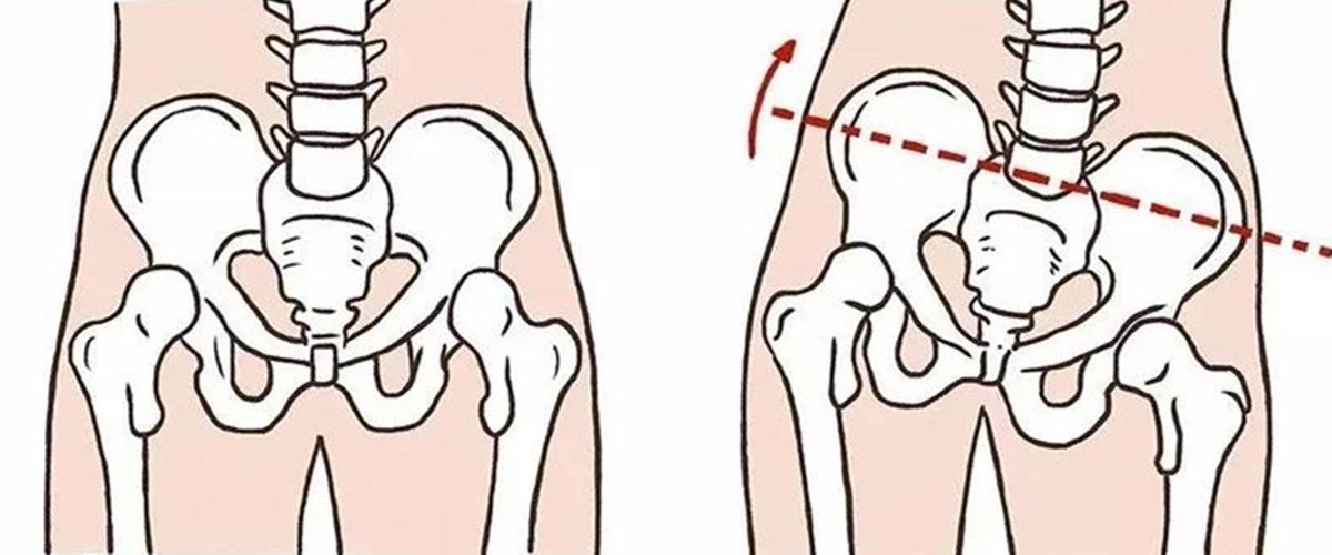 骨盆倾斜—正成为你身体健康的隐形杀手