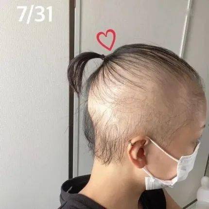 日本花季少女接种疫苗后一个月成秃头,疫苗副作用可致