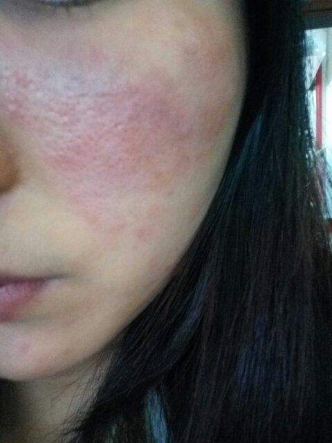 最近脸上突然一片红,不知道这是过敏了还是怎样,请各位大神看看这是