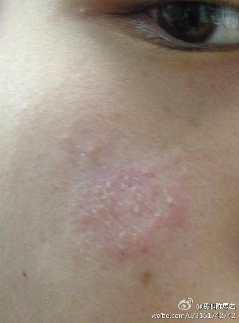 脂溢性皮炎,擦了很多药都没有好,现在发炎的部位那里脱皮严重,还有些