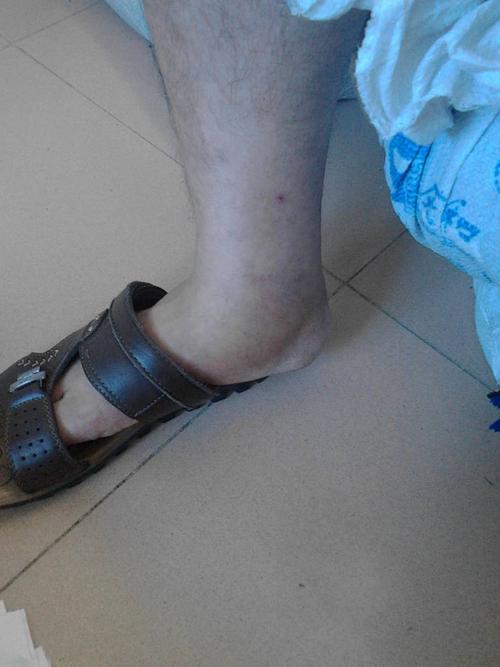 男人脚肿了一个多月了,去医院检查医生说肝,肾都没问题开了一些药吃