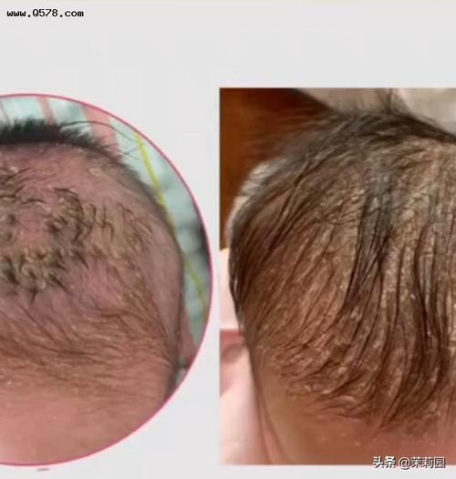 新生儿出生头上没有头垢,反而三个月后开始长头垢,这是怎么一回事?