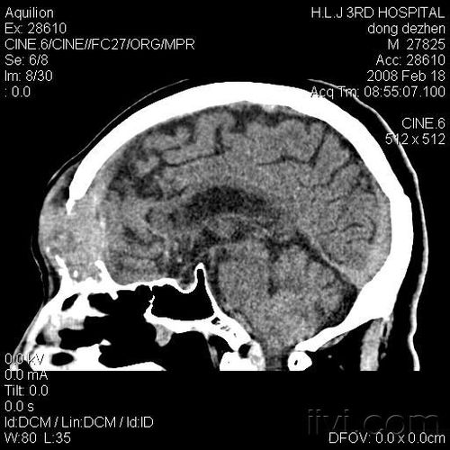 头部ct请大家看看