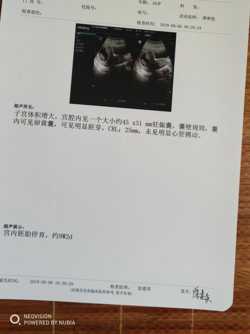 孕8周有胎心胎芽10周胚胎停育怎么回事