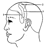 图1 颞顶部应用解剖示意图   颞浅动脉额支 2 颞筋膜瓣 3 颞浅动脉顶