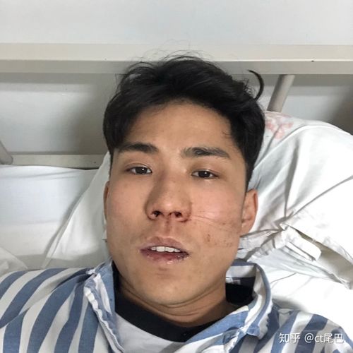 鼻中隔偏曲手术很恐怖吗?