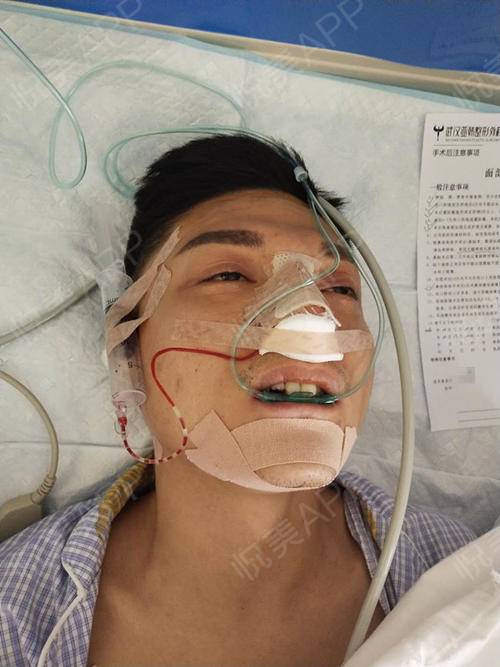 膨体假体垫下巴手术当天_垫下巴手术当天_面部轮廓手术当天_里约分享