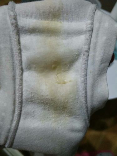 这样的内裤正常吗,是不是霉菌性阴道炎啊,严重吗?无异味不瘙痒.