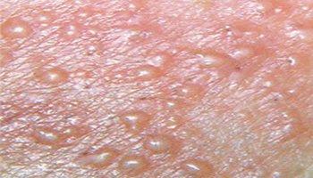 非淋菌性尿道炎症状