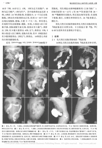先天性巨结肠类缘病的x线诊断_与先天性巨结肠对照分析_王龙胜.