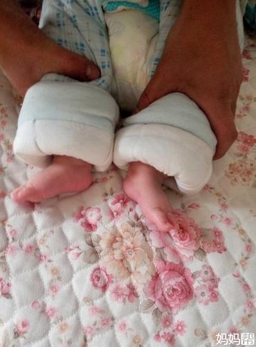 我孩子足外翻
