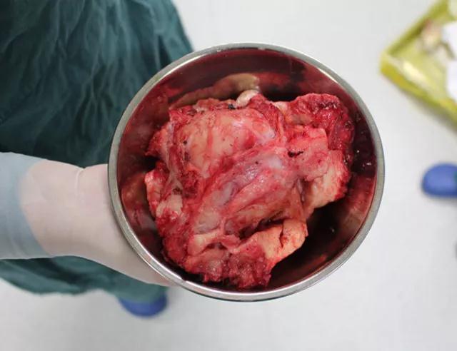 美德因成功实施首例腹腔镜下子宫全切术 用行动守护健康!