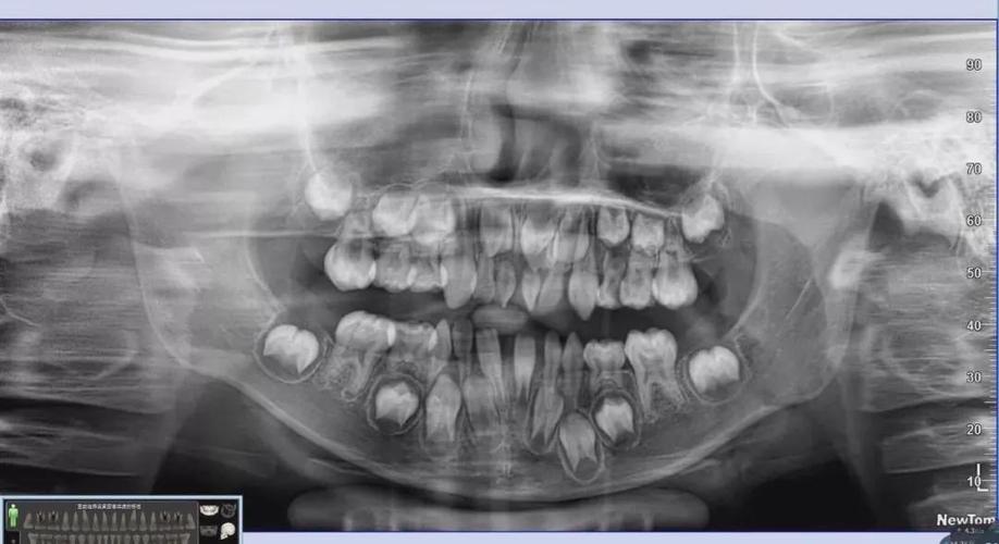 看牙为什么要拍x光片?_牙齿