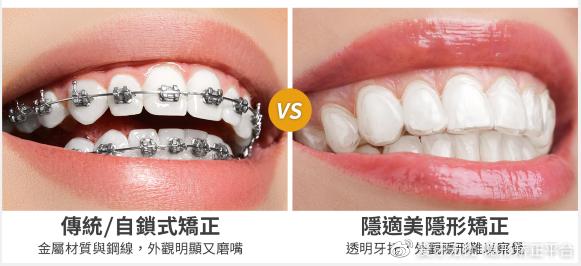 隐形矫正科普5正畸要多少钱隐适美时代天使正雅