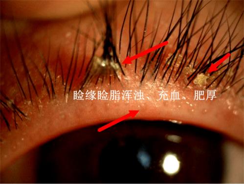 睑缘炎是一种伴有眼睑炎症的慢性眼病,目前没有明确的病因,可能与化妆