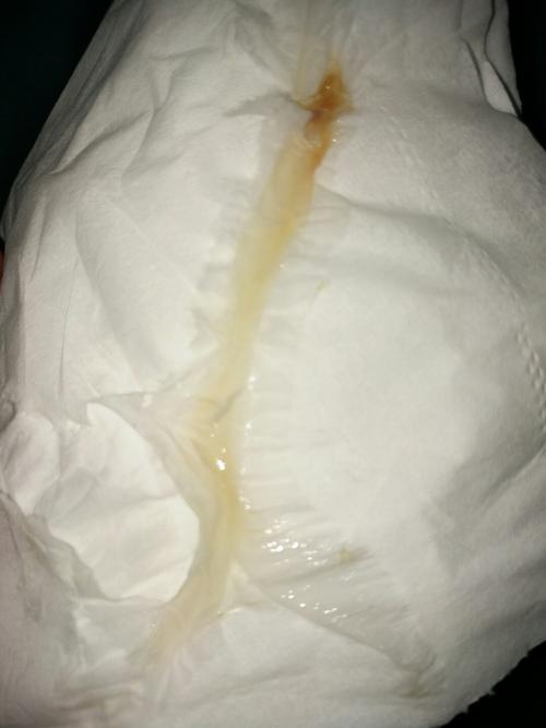 排卵期这白带正常吗