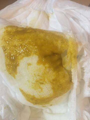 这样的便便是乳糖不耐受吗?