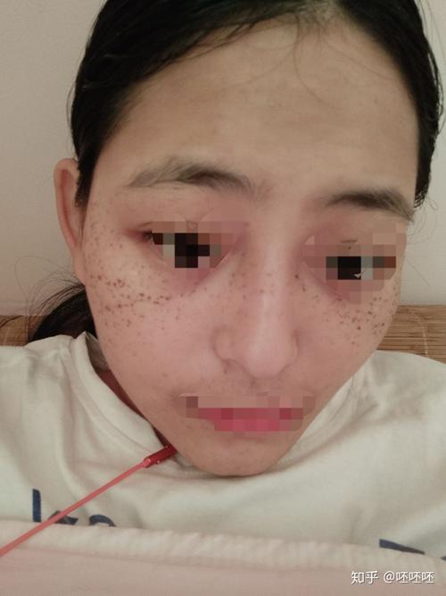 南昌第二附属医院激光祛雀斑记录(遗传雀斑)*