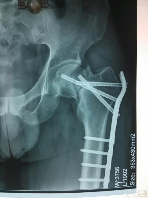 股骨颈骨折(头下型),有术后片!