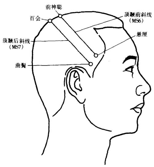 头针穴位图